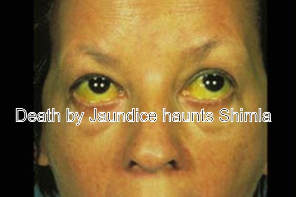 Jaundice haunts Shimla as another victim dies - Hill Post